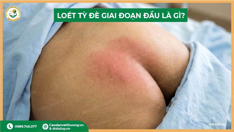 loét tỳ đè giai đoạn đầu là gì?