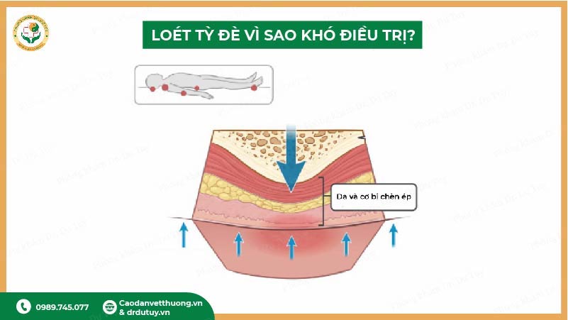 loét tỳ đè vì sao khó điều trị