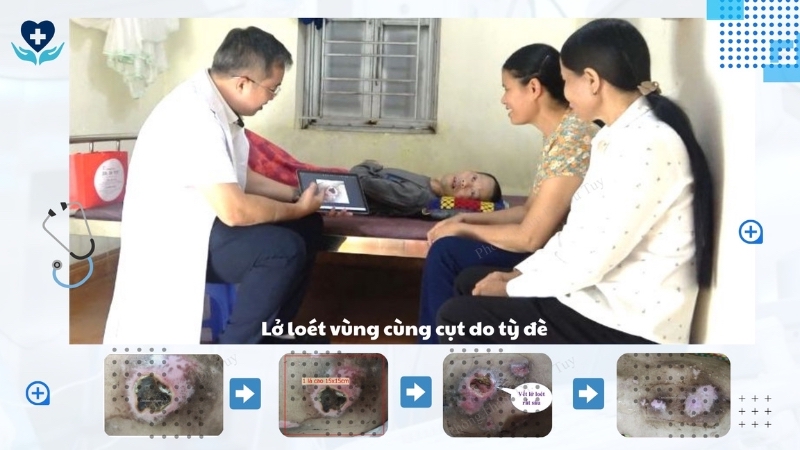 loét vùng cùng cụt do tỳ đè