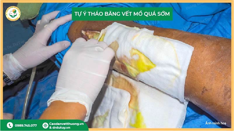 lỗi tự ý tháo băng vết mổ quá sớm