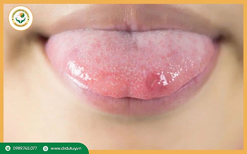 Lưỡi bị lở loét: Nguyên nhân, dấu hiệu và cách chữa hiệu quả