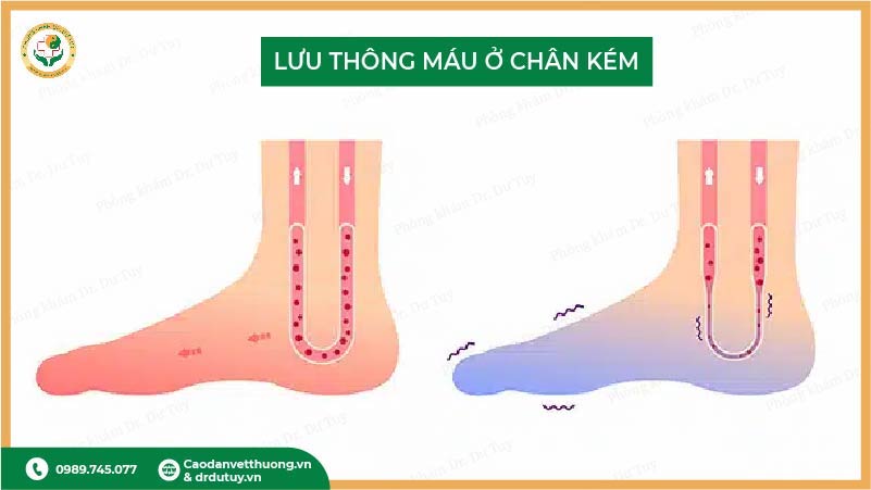 lưu thông máu kém chi dưới vết thương lâu lành