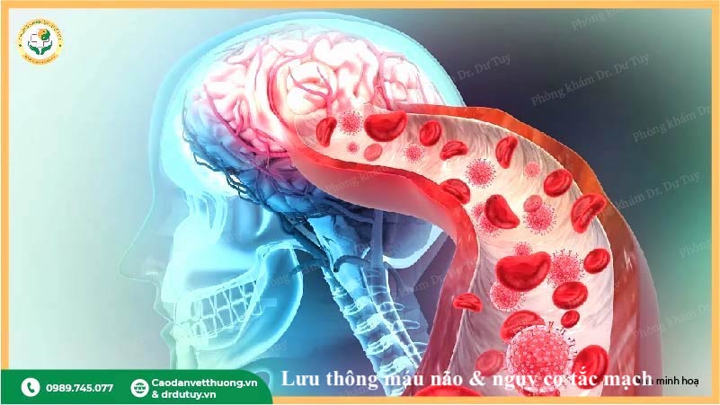 lưu thông máu não và nguy cơ tắc mạch
