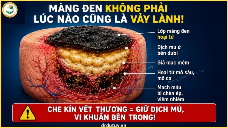 mảng đen hoại tử vết loét vùng cùng cụt