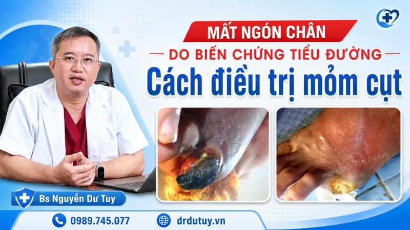 Mất ngón chân do biến chứng tiểu đường và cách điều trị mỏm cụt