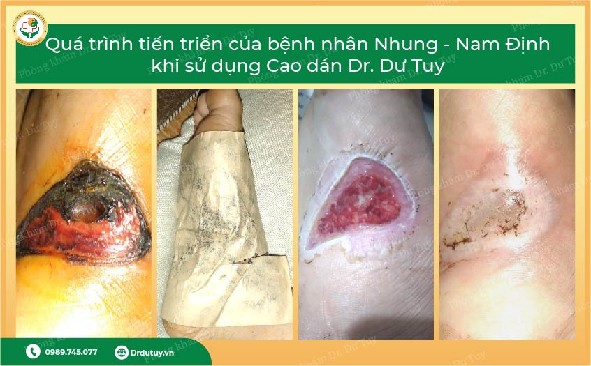 miếng dán trị bỏng