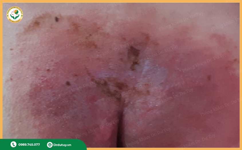 miếng dán chống loét