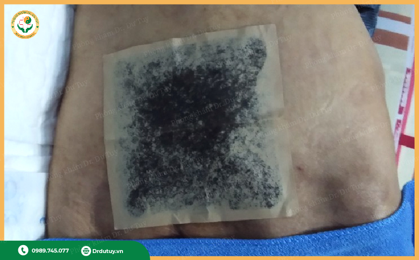 miếng dán chống loét