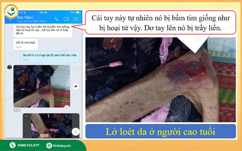 miếng dán chống loét