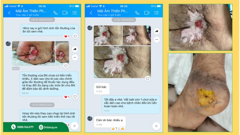 miếng dán chống loét cho người già