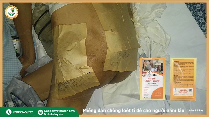 miếng dán chống loét tì đè