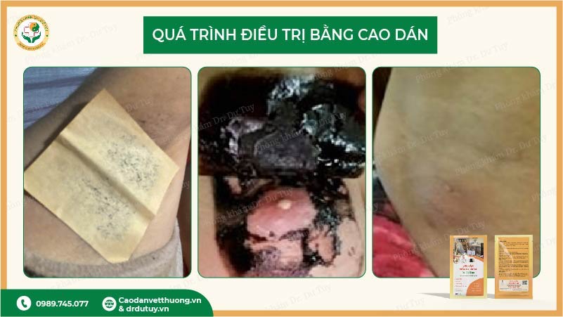 miếng dán hút mủ áp xe