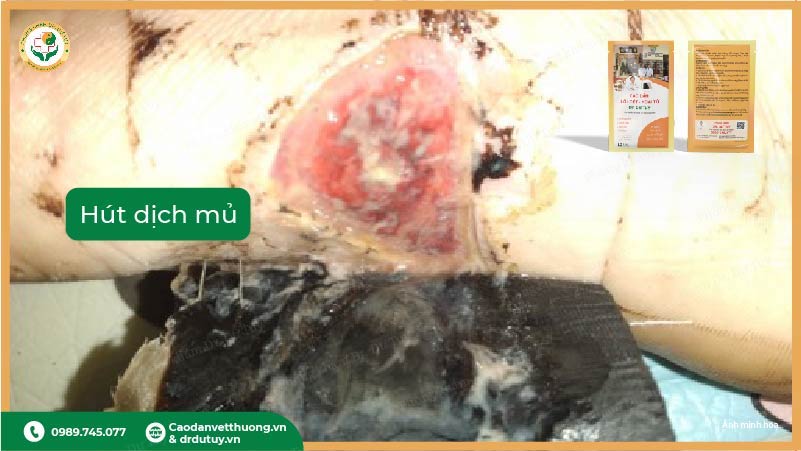 miếng dán thảo dược hút mủ