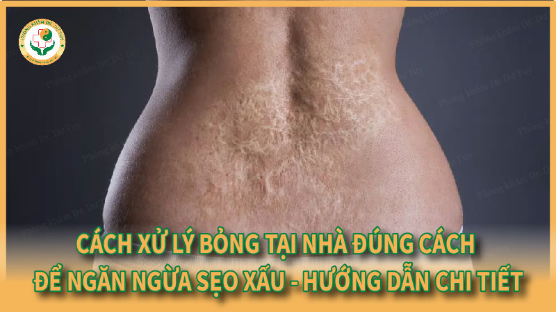 Cách xử lý bỏng tại nhà đúng cách để ngăn ngừa sẹo xấu – Hướng dẫn chi tiết