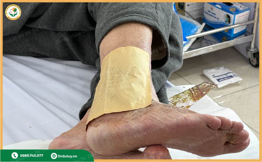 miếng dán trị lở loét da