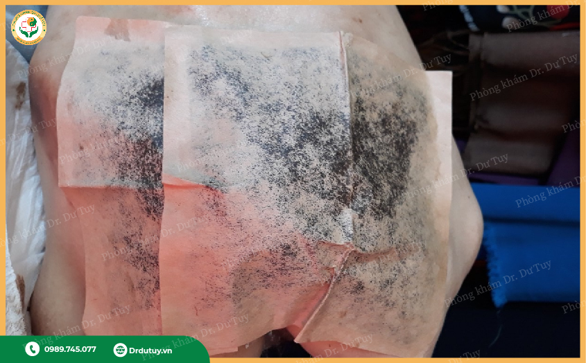 miếng dán trị loét da