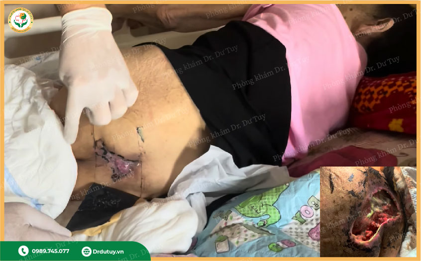 miếng dán trị loét da người già