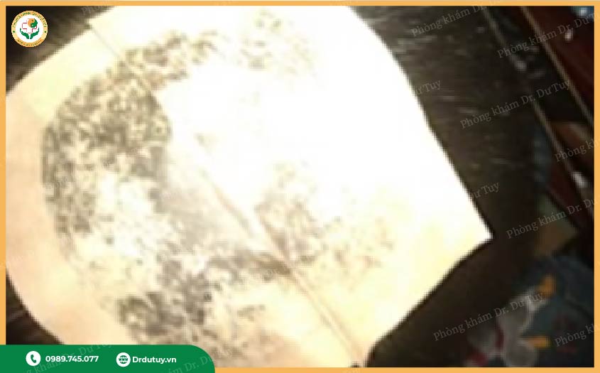 miếng dán trị viêm da đầu trẻ nhỏ