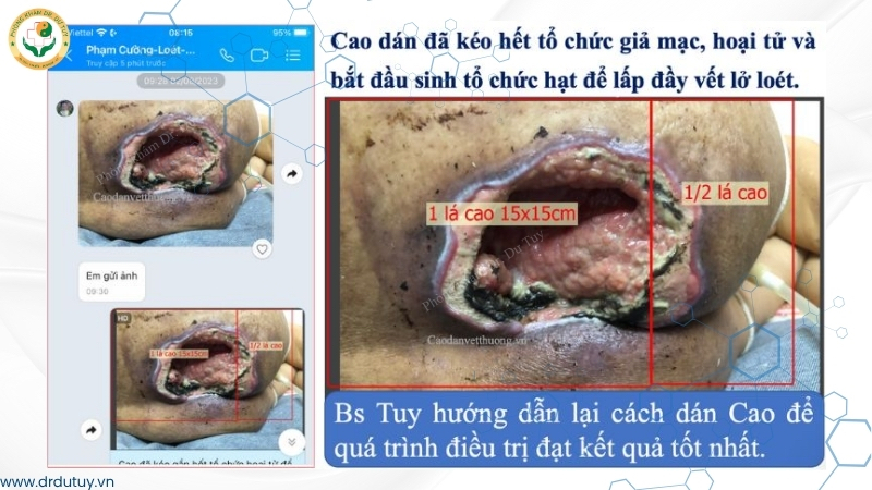mô hạt hình thành trong vết loét
