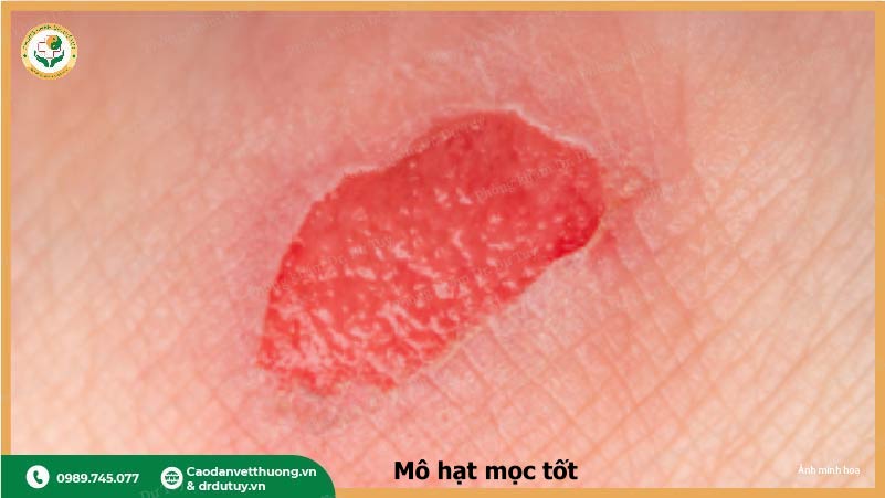 mô hạt trong quá trình lành vết loét