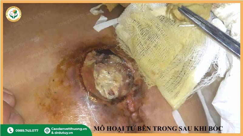 mô hoại tử âm thầm sau thuốc tạo màng
