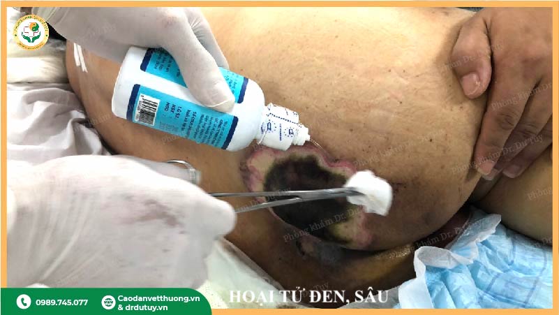 mô hoại tử đen trong vết lở loét