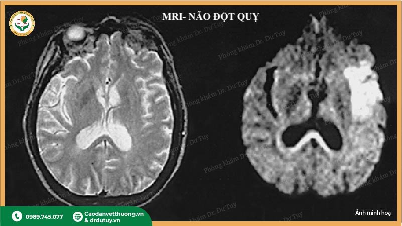 MRI não đột quỵ