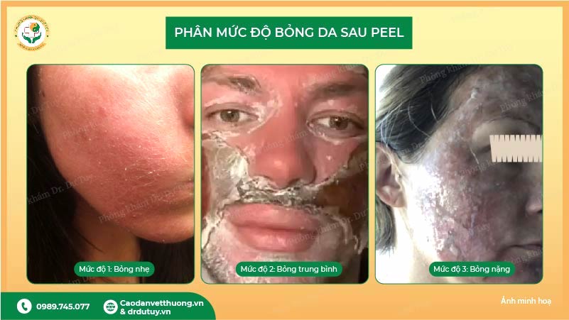 mức độ bỏng da sau peel bỏng nhẹ, trung bình, nặng
