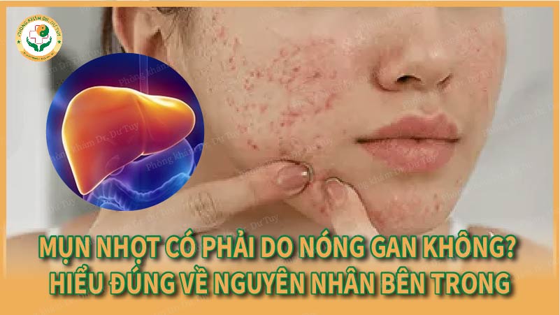Mụn nhọt có phải do nóng gan không? | Hiểu đúng về nguyên nhân bên trong
