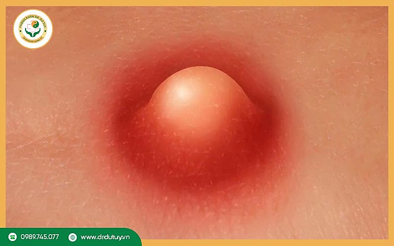 Mụn nhọt là gì? Nguyên nhân, triệu chứng và cách điều trị hiệu quả