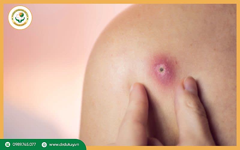 Biến chứng của mụn nhọt