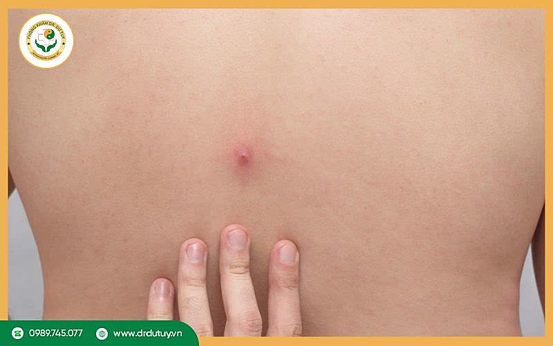 Mụn nhọt lưng là gì?