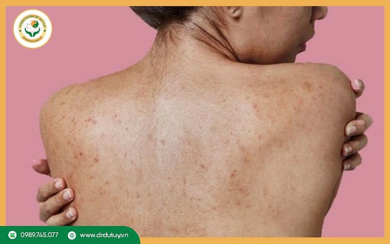 Nguyên nhân gây mụn nhọt ở lưng