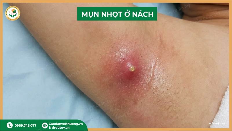 mụn nhọt ở nách là gì?
