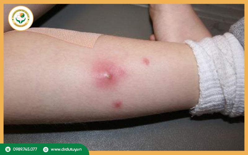 Mụn nhọt sưng to đau nhức có nguy hiểm không? 