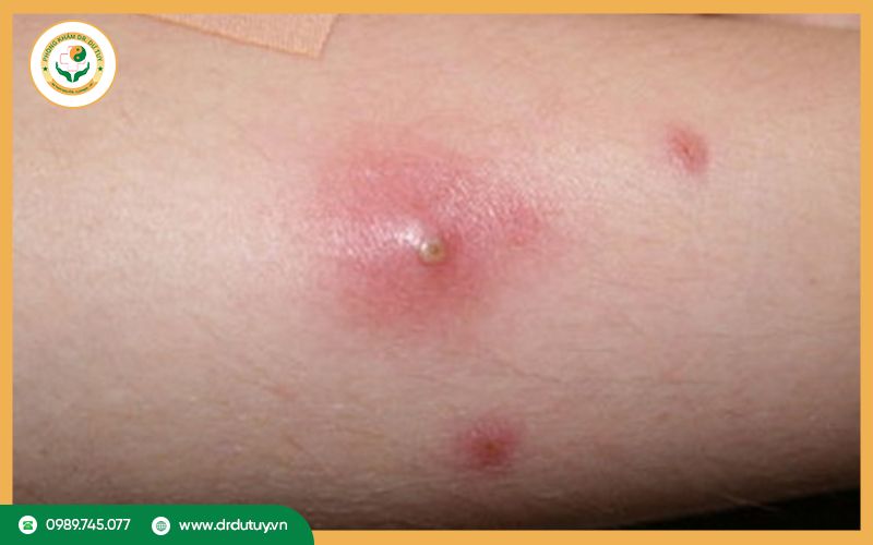 Nguyên nhân dẫn đến mụn nhọt tái phát nhiều lần
