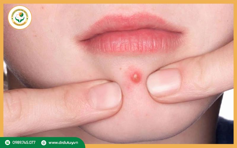 Tại sao mụn nhọt tái phát nhiều lần?