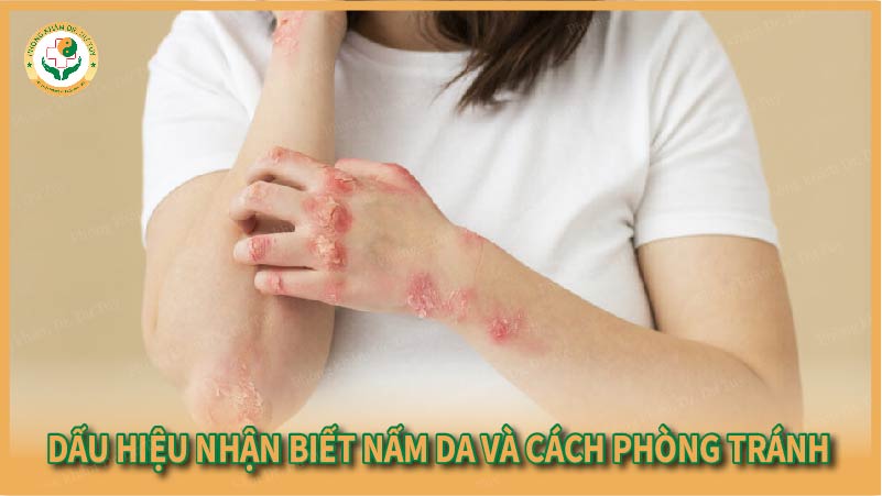 Dấu hiệu nhận biết nấm da và cách phòng tránh