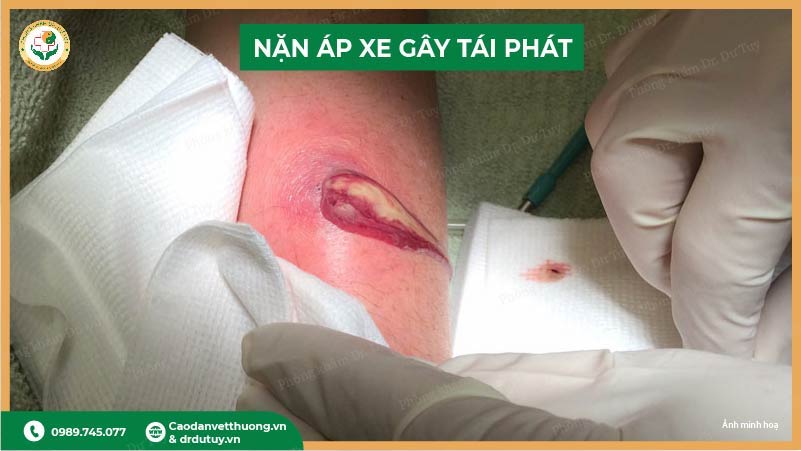 nặn áp xe sai cách