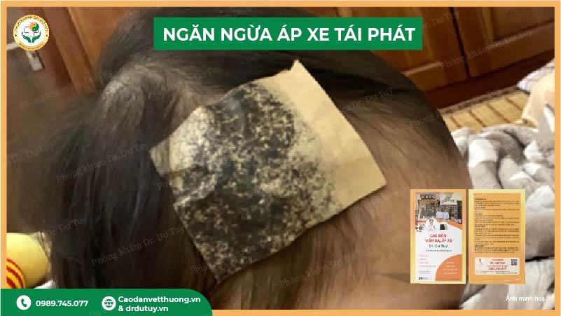 ngăn ngừa áp xe tái phát