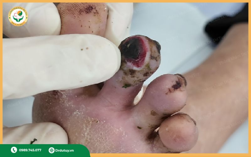 Ngón chân bị lở loét là bệnh gì?