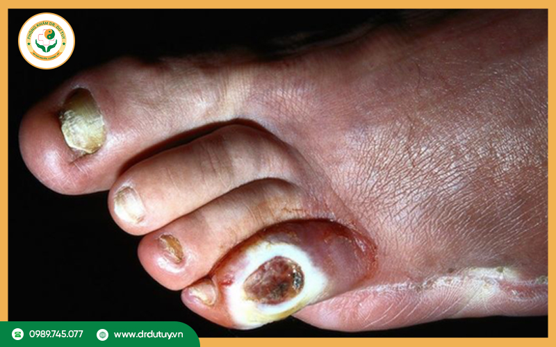 Phân loại lở loét ở chân
