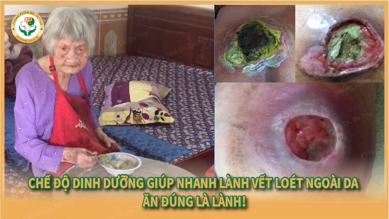Người bị loét tì đè nên ăn gì để vết loét nhanh lành