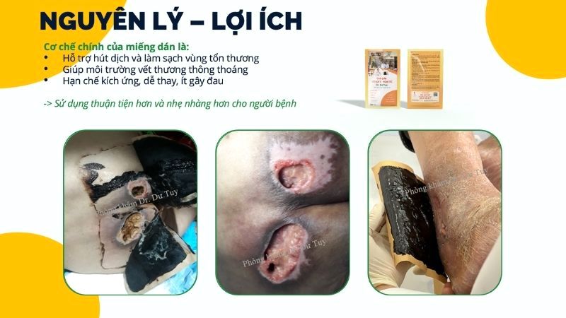 nguyên lý hút dịch làm sạch thông thoáng vết loét