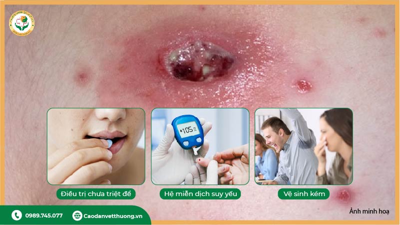 nguyên nhân áp xe tái phát