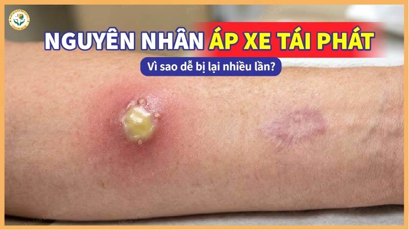 Nguyên nhân áp xe tái phát: Vì sao dễ bị lại nhiều lần?