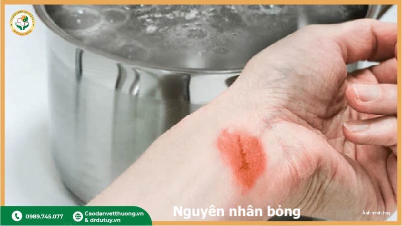 nguyên nhân bỏng ngoài da nước sôi