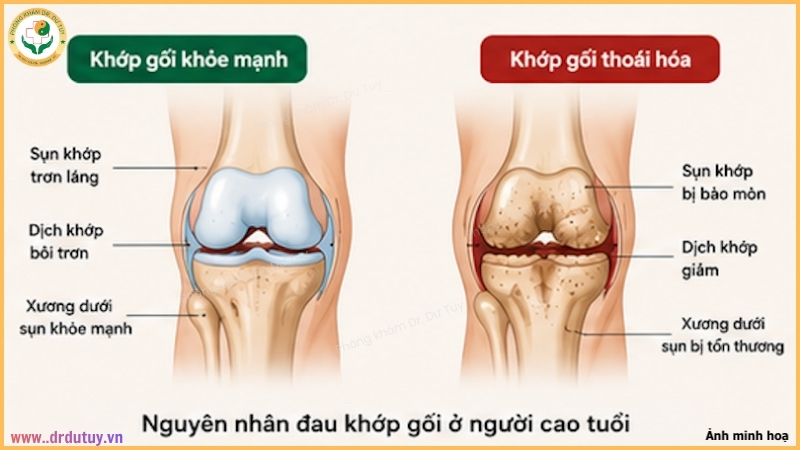 nguyên nhân đau khớp gối ở người cao tuổi