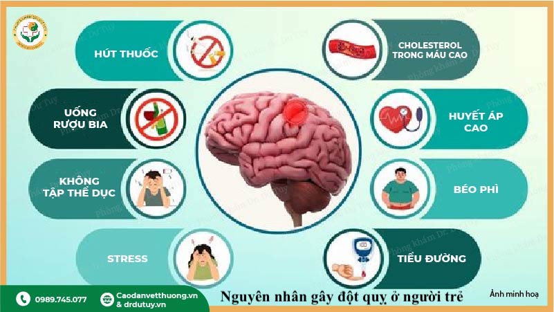 nguyên nhân đột quỵ người trẻ