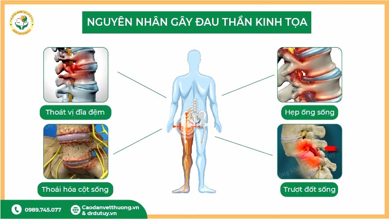 nguyên nhân gây đau thần kinh toạ thoát vị đĩa đệm